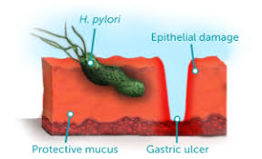 Unknown Bacteria that Infects Your Gut! H-Pylori